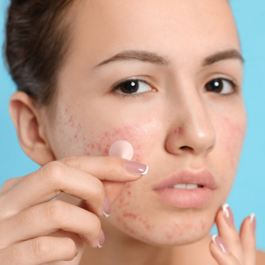 PatchAway: Clear Acne Solution